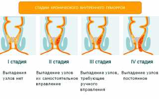 Симптомы и лечение геморроя 4 степени