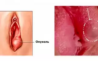 Отек половых губ при беременности
