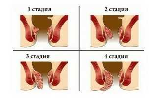 Через сколько дней проходит геморрой и долго ли он лечится