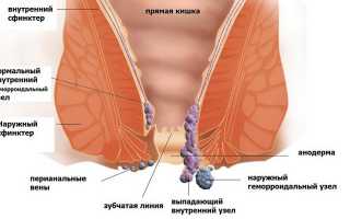 Лечение геморроя народными средствами