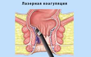 Как проводится удаление геморроя лазером?