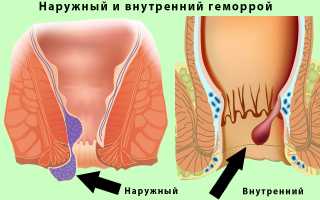 Продолжительность лечения геморроя