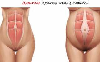 Диастаз после родов