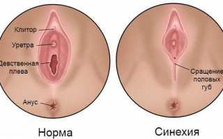 Синехии половых губ