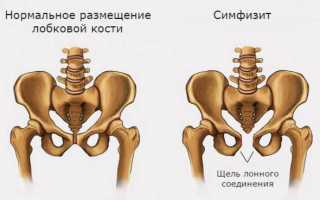 Расхождение лонных костей (симфизит) после родов