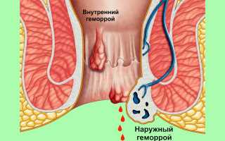Лечение геморроя