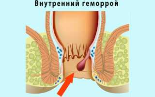 Способы лечения внутреннего геморроя в домашних условиях