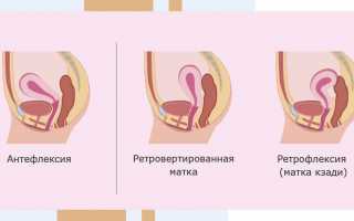Беременность при загибе матки