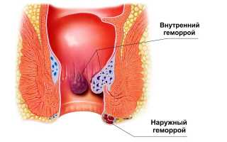 Ванночки с марганцовкой при геморрое