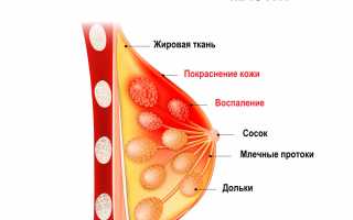 Мастит