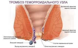 Тромбоз геморроидальных узлов: причины и симптомы