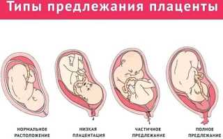 Краевая плацента