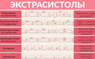 Разновидности и последствия экстрасистолии