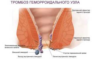 Что такое тромбоз наружного геморроидального узла