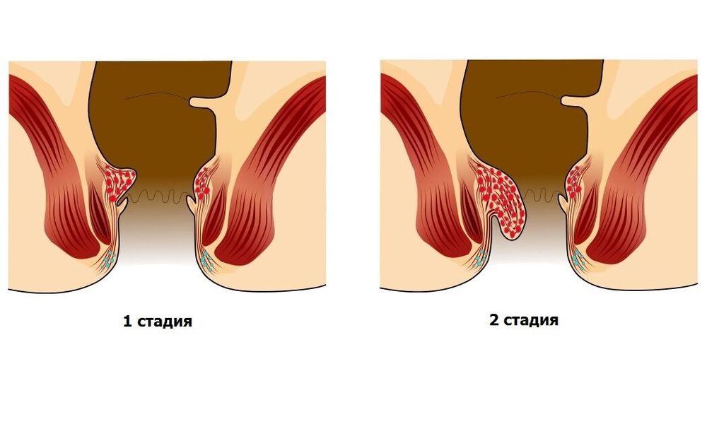 Для лечения геморроя 1 и 2 стадии наиболее подходящими являются прохладные, паровые и дымовые ванночки