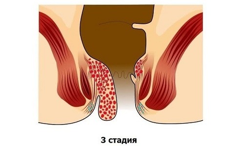 Геморрой 3 стадии доставляет пациентке множество неприятных ощущений