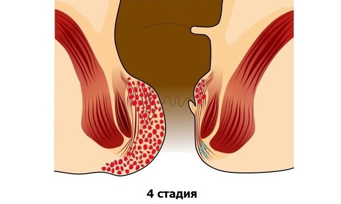 При тяжелом геморрое из-за постоянной потери крови у больного со временем развивается постгеморрагическая анемия