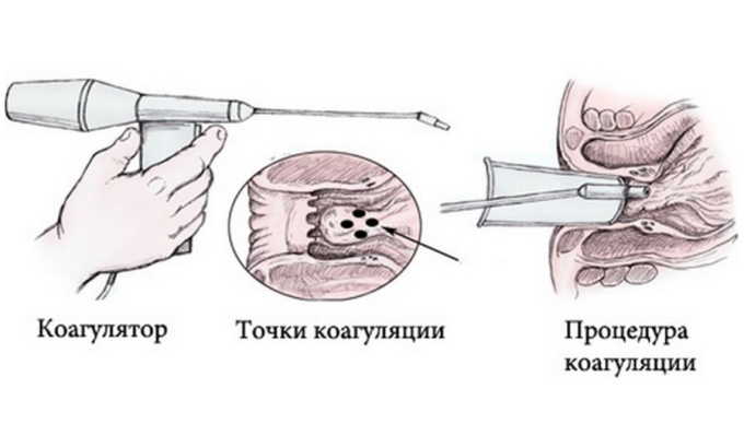 Методика коагуляции заключается в использовании инфракрасных или лазерных лучей, которые подаются на геморроидальный узел