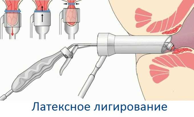 Методика лигирования заключается в том, что на геморроидальный узел надевается специальное кольцо из латекса, нарушающее кровоснабжение