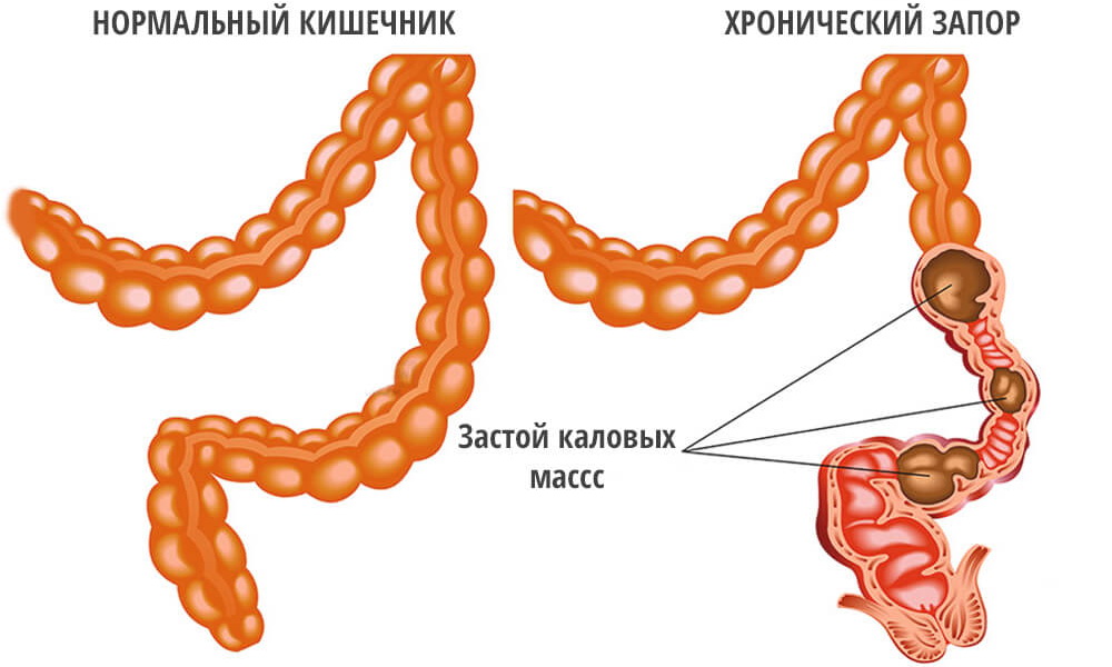 Запор диагностируется при задержке стула более 48 часов. Если запор возникает при геморрое, то повышается риск инфицирования слизистой оболочки анального отверстия в результате попадания в микротрещины патогенной флоры