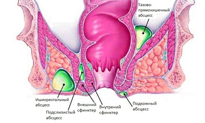 Четвертая стадия геморроя может осложняться парапроктитом. Он развивается при проникновении инфекции в окружающие ткани. При отсутствии лечения ткани отмирают