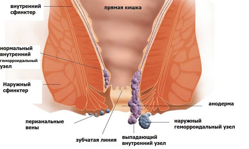Геморрой - это заболевание венозных сплетений прямой кишки, при котором происходит патологическое изменение геморроидальных узлов, склонных воспаляться, кровоточить и выпадать наружу