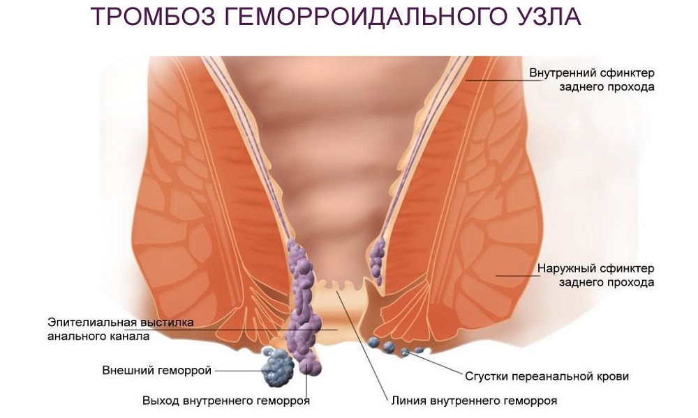 Тромбоз наружного геморроидального узла в большинстве случаев является результатом отсутствия направленного лечения хронической формы геморроя