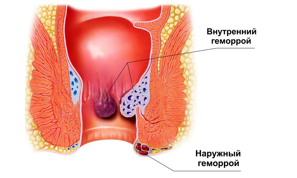 Обнаружить геморрой у ребенка можно только на этапе воспаления сосудов прямой кишки