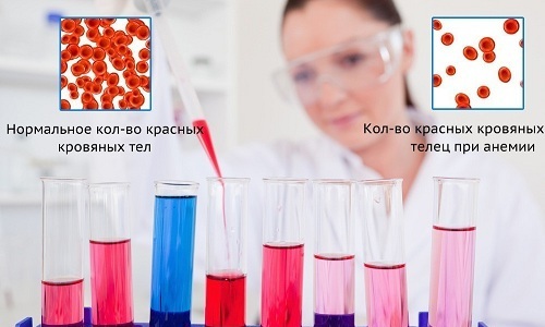 При 3 стадии геморроя могут наблюдаться сильные кровотечения, которые ведут к анемии