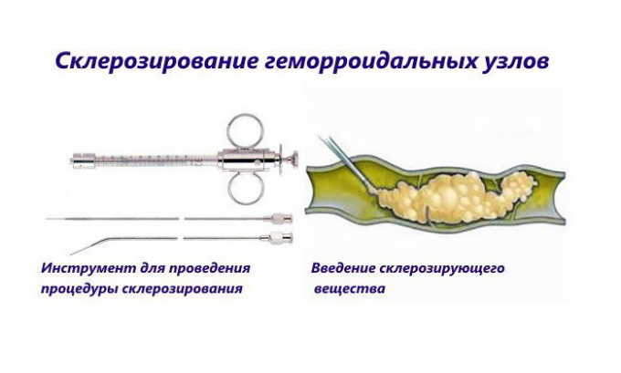 Процедура склерозирования геморроидальных узлов осуществляется в амбулаторных условиях и занимает не более 10 минут