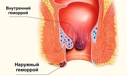 Очень часто человек страдает от комбинированной формы геморроя