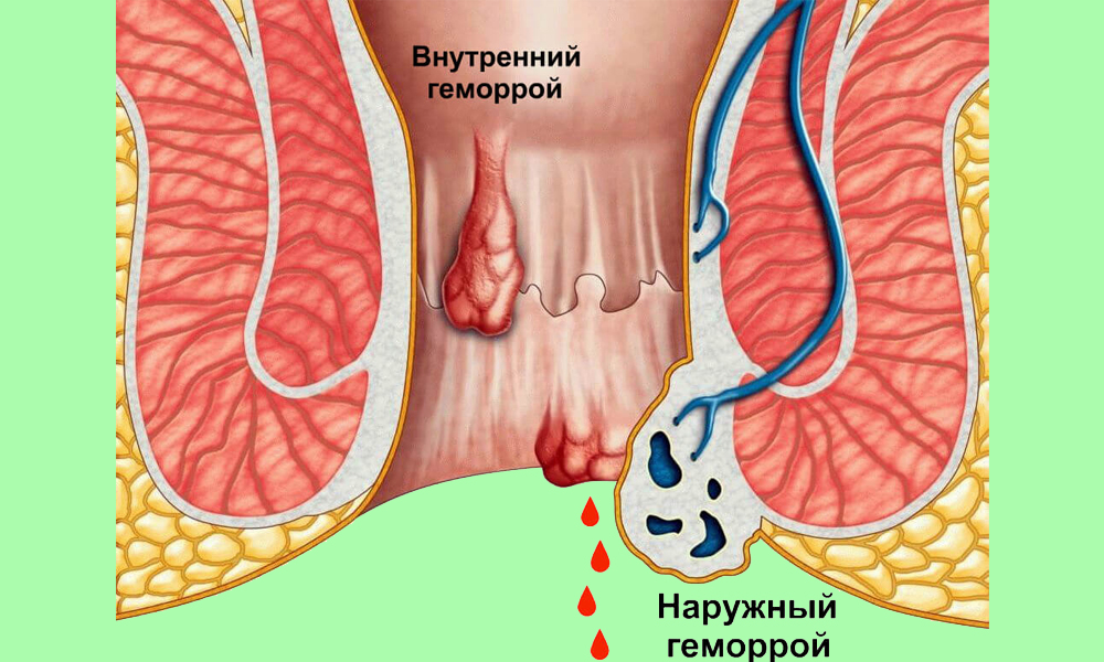 Геморрой имеет 4 стадии развитии и при отсутствии своевременного лечения часто приобретает форму хронического