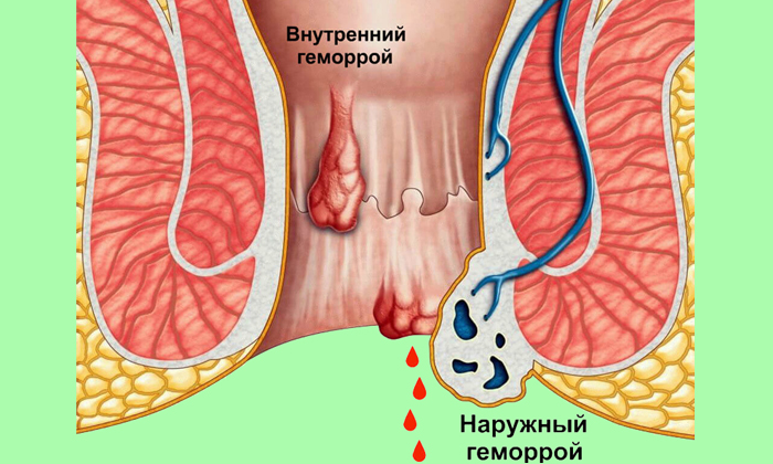 Кровь при дефекации при геморрое - характерный симптом заболевания