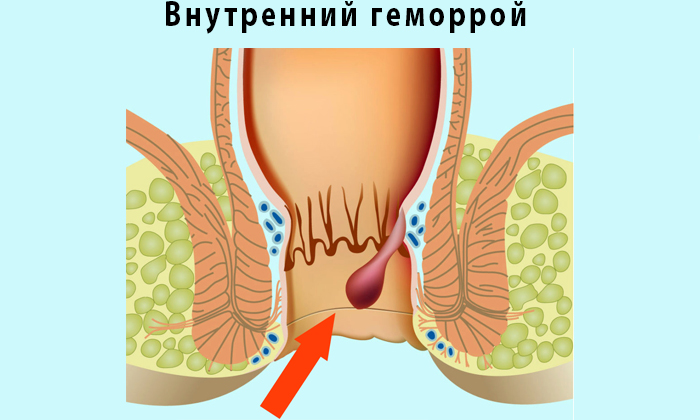 Прополис ДН снижает воспаления геморроидальных узлов