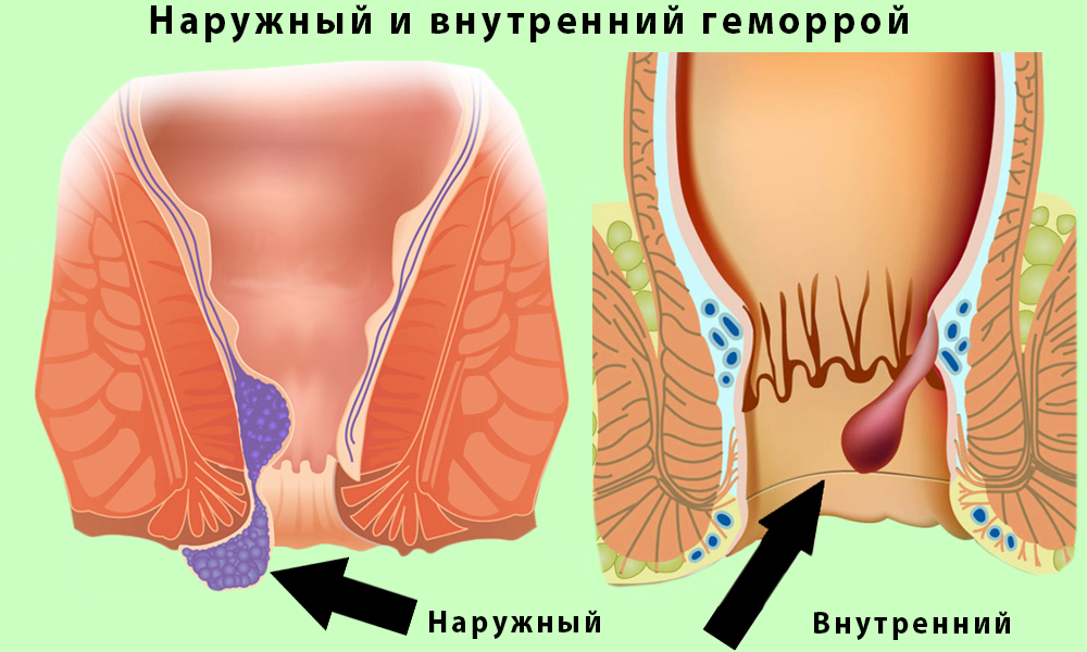 Геморрой — это заболевание, которое характеризуется варикозным расширением и тромбозом вен в результате нарушения кровообращения в сосудах геморроидальных сплетений нижнего отдела прямой кишки