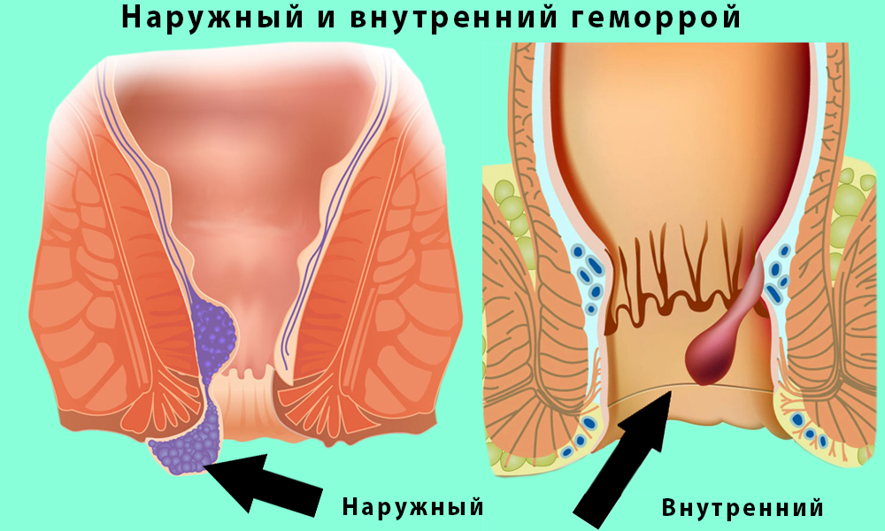 Инъекцию склерозанта вводят при развитии внутренних геморроидальных узлов