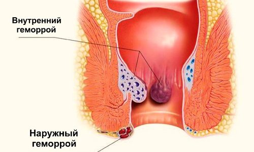 При расширении анальных вен возникает достаточно неприятное, а иногда и опасное для здоровья заболевание — воспаление геморроидальных узлов