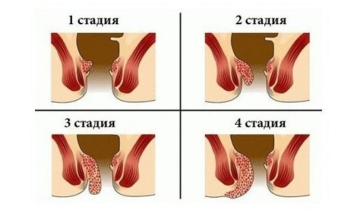 Дезартеризацию можно использовать для лечения геморроя на любой стадии