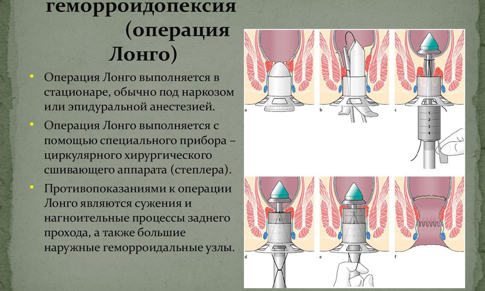 Геморроидопексия применяется при геморрое в тяжелых случаях заболевания