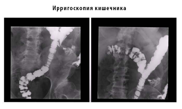 Ирригоскопия это исследование слизистой оболочки толстой кишки с помощью рентгена