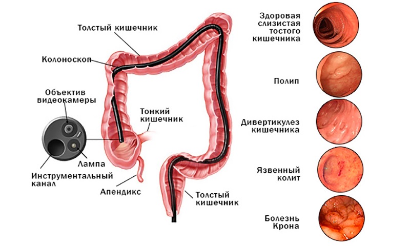 Колоноскопия используется для выявления сопутствующих патологий толстого кишечника