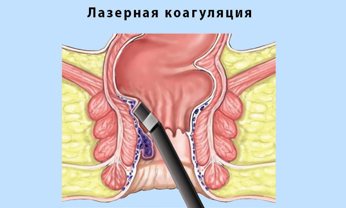 При выполнении лазерной коагуляция внутренние узлы геморроя выжигаются изнутри, а внешние — иссекаются