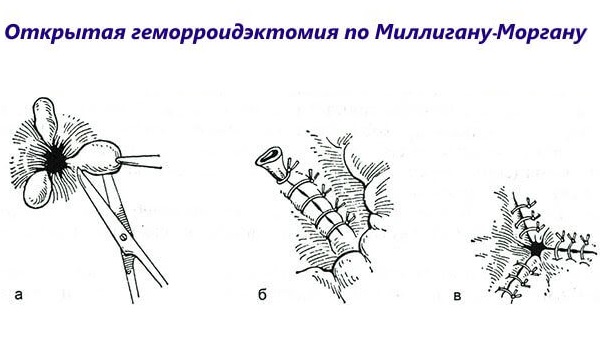 Оперативное лечение по методу Миллигана-Моргана подразумевает одновременное иссечение нескольких наружных и внутренних узлов с частью кожи и слизистой, расширенные сосуды прошиваются