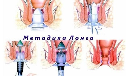 В процессе операции Лонго происходит подтяжка слизистой оболочки, расположенной выше геморроидальных узлов