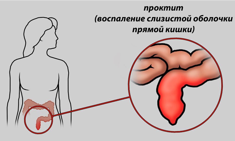Проктит является показанием к использованию ректальных суппозиториев с прополисом