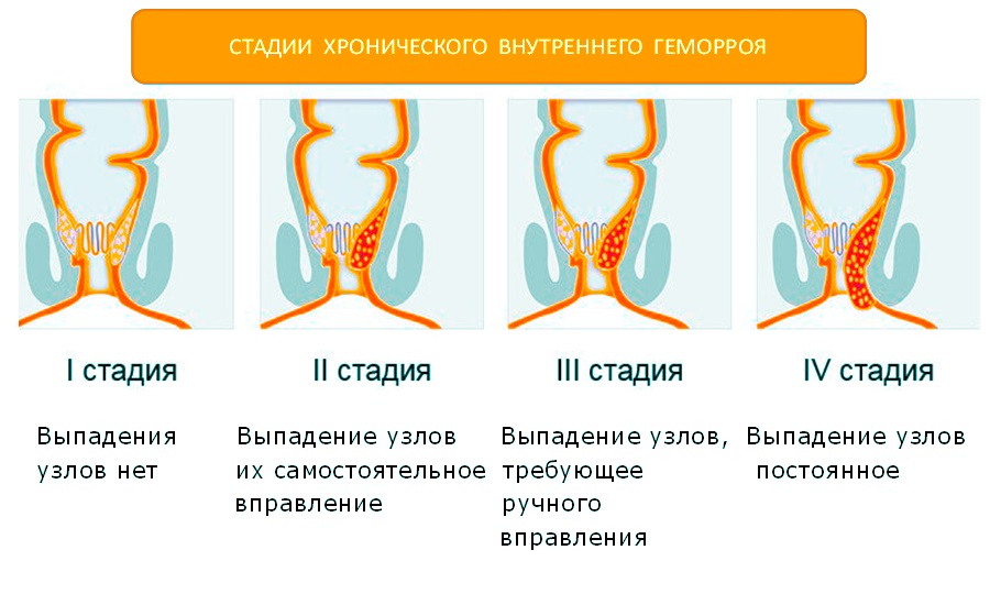 Из всех стадий геморроя, четвертая стадия наиболее тяжелая и опасная форма заболевания, характеризующаяся наличием внутренних и внешних узлов