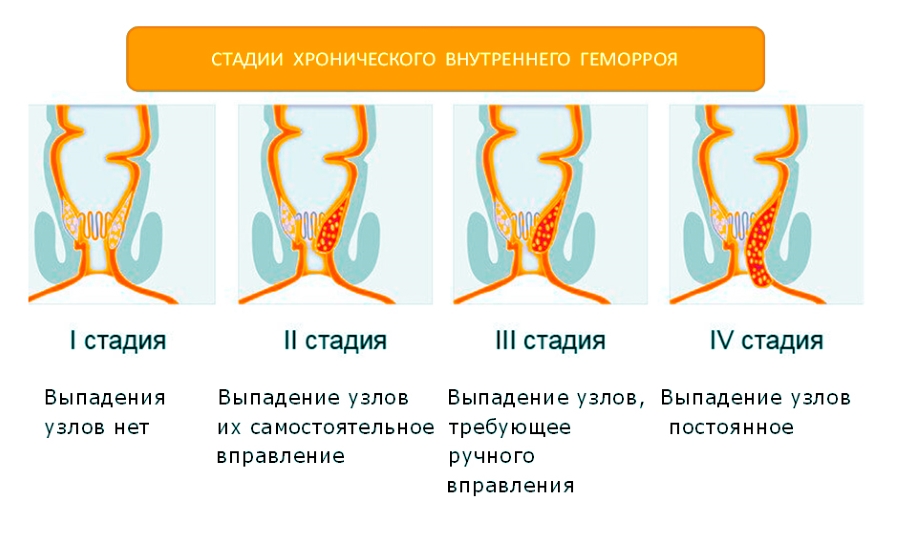 Геморрой проходит четыре стадии развития