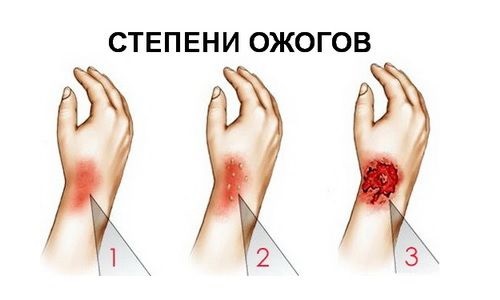 Марганцовка может оставлять ожоги, пользоваться ей нужно предельно осторожно.