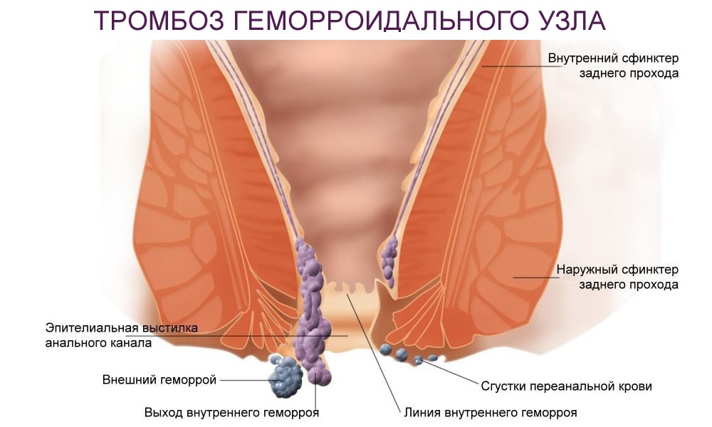Принимать горячие ванны нельзя при тромбозе