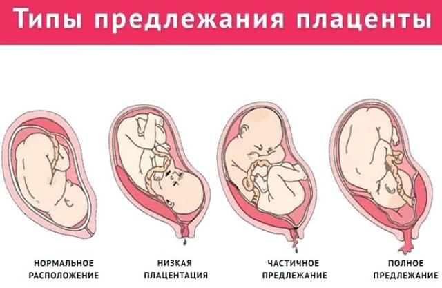 Краевая плацента